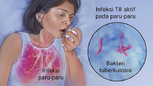 Penyakit tbc merupakan penyakit yang menyerang
