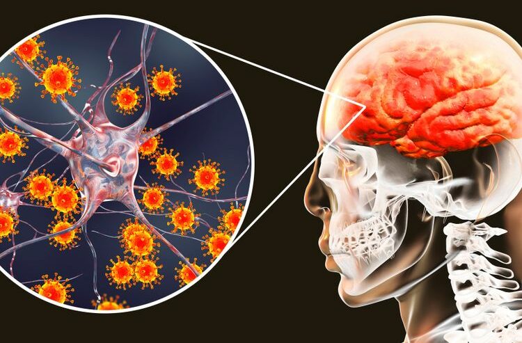 Ilustrasi penyakit meningitis.