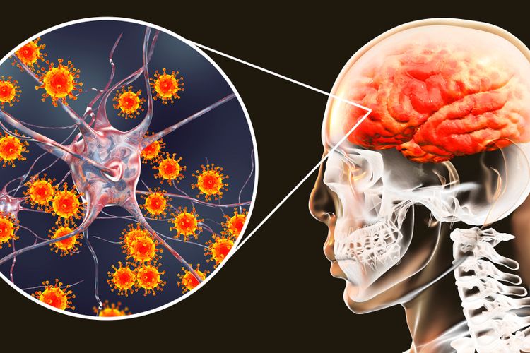 Ilustrasi penyakit meningitis.